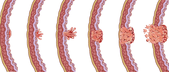 Bladder cancer stages and types