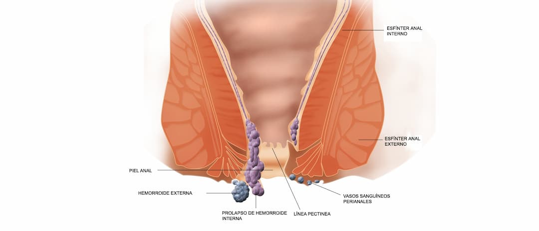 Piles (Hemorrhoids): symptoms and home remedies