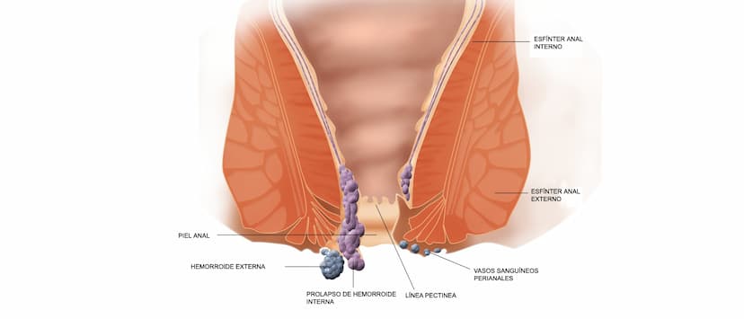 Piles (Hemorrhoids): symptoms and home remedies