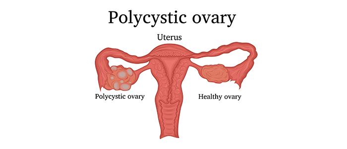 Polycystic Ovary Syndrome (PCOS): Understanding Causes, Symptoms, and Treatments