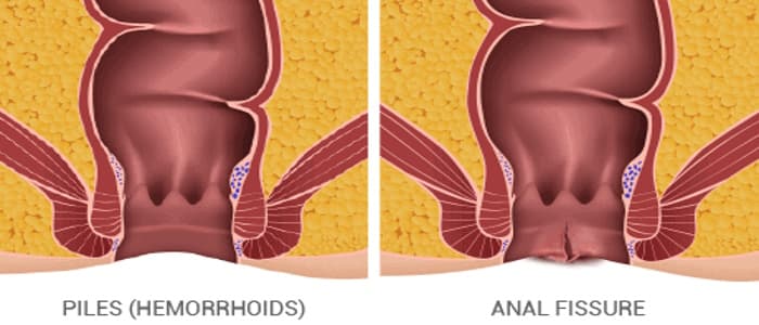 The Key Difference Between Piles and Fissures